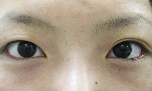 白い 👌下 瞼 マイボーム腺炎、マイボーム腺梗塞（よくある目の病気 9)